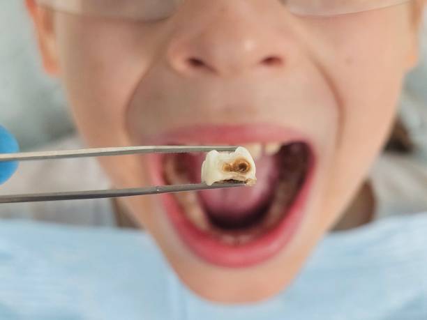 Best Emergency Dentist for Lost Fillings or Crowns in West Union, OH